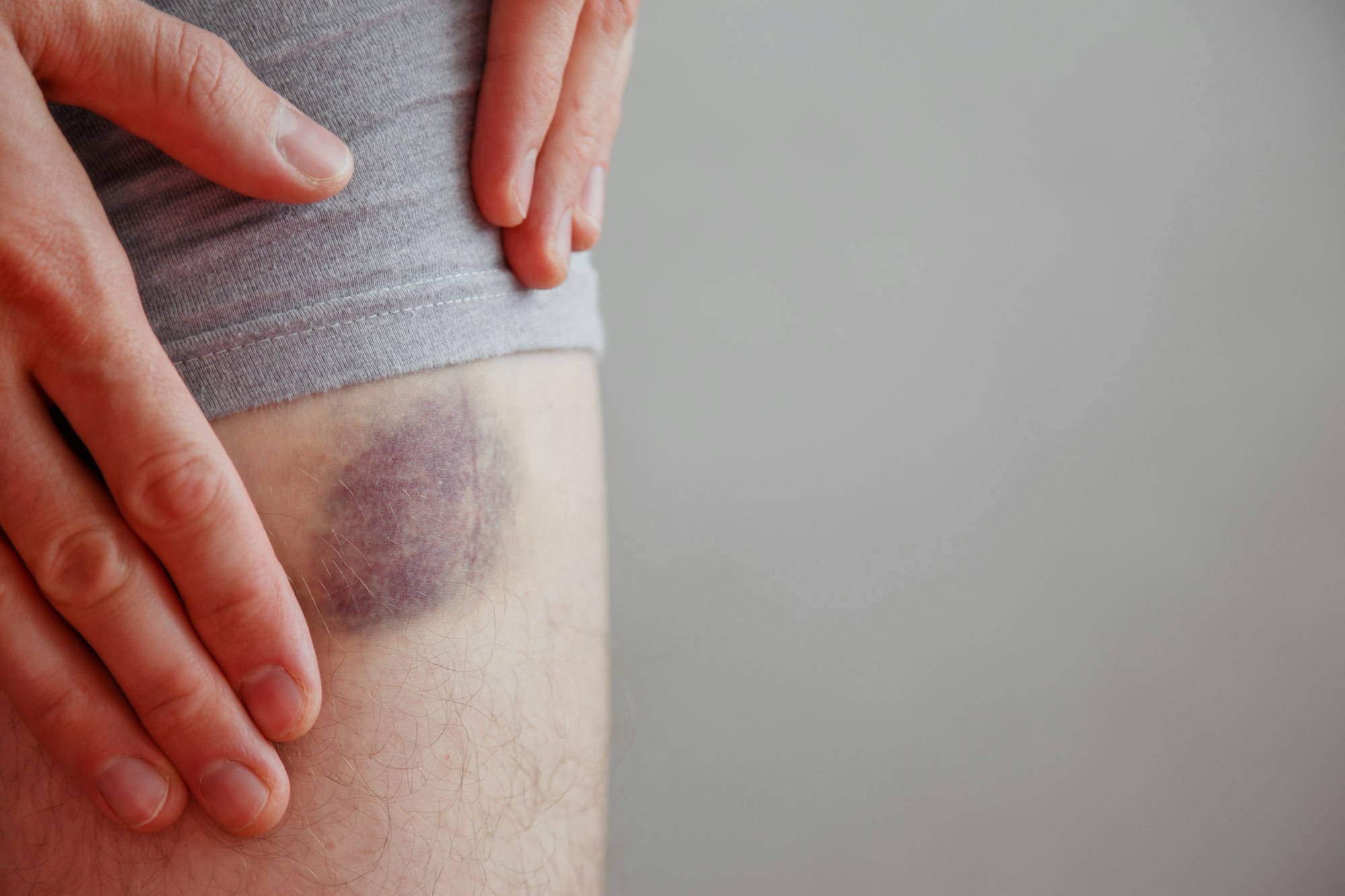 A person with bruises on their knee.