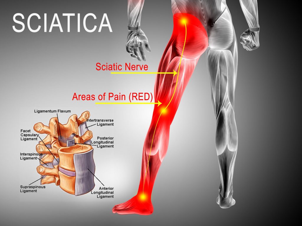 Sciatica Relief in North Charleston, SC