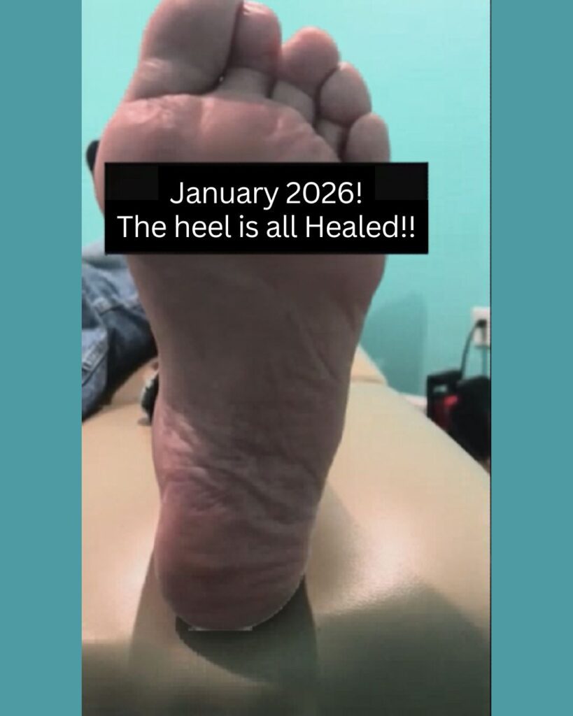 Ken heel fully healed after neuropathy treatment in North Charleston SC
